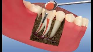 Reconstitution dentaire foulée￼ après dévitalisation molaire [upl. by Araiek]