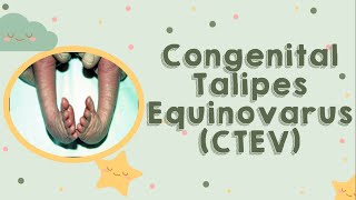 Congenital Talipes Equinovarus CTEV [upl. by Ashby]