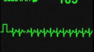 Supraventricular Tachycardia  SVT  ECG Simulator  Arrhythmia Simulator [upl. by Rew]