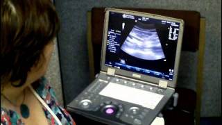 Abdominal Aortic Aneurysm screening demonstration [upl. by Nylatsirk531]