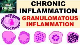 INFLAMMATION Part 9 Chronic Inflammation  GRANULOMATOUS INFLAMMATION [upl. by Bartholomeo]