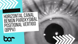 Eye Movements for Horizontal Canal BPPVTDTM episode 2 [upl. by Ahsaeit]