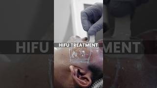 What is a HIFU Facelift and how is it performed at Skinaa Clinic viral shorts [upl. by Esorylime]