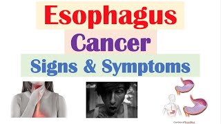 Esophageal Cancer Signs amp Symptoms amp Why They Occur [upl. by Eintroc]