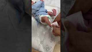 clubfoot treatment through ponseti techniques [upl. by Voe]