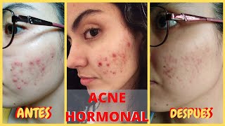 TRATAMIENTO ACNÉ HORMONAL  COMO ELIMINAR EL ACNÉ HORMONAL  NATURAL  BEYOURSELF [upl. by Hsital]