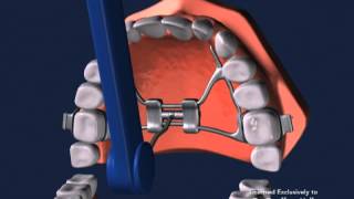 Advanced Orthodontics  Expanders [upl. by Odlanyer396]