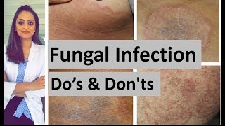 Fungal infection of skin  Dos and Donts  Dermatologist  Dr Aanchal Panth [upl. by Aubrey564]