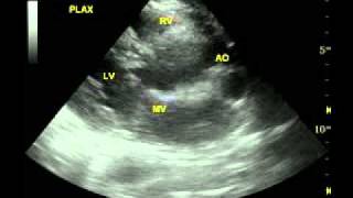 Normal parasternal long axis PLAX echowmv [upl. by Dumond]