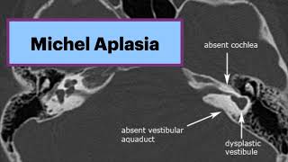 Michel Aplasia  Complete Labyrinthine Aplasia Radiology Radiology ENT Ear [upl. by Sheffy]