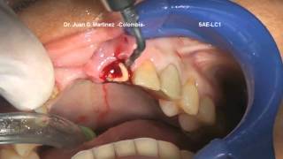 Crown Removal with 5AETip amp Tooth Extraction with LC1Tip DrJuanMartinez [upl. by Analeh]