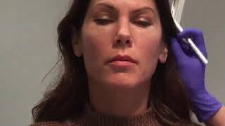 Cheek Filler Using Radiesse With Dr Nancy Kim [upl. by Natek]