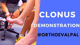 Clonus Demonstration with Ortho Eva Pal [upl. by Petunia]