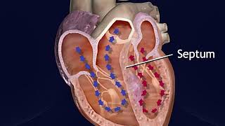 Hypertrophic Obstructive Cardiomyopathy Animation  Treatment Procedure for HOCM Video [upl. by Nuarb]