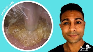 1485  Masses of Dead Skin Removed from Both Ears  Learn About Different Ear Wax Drops [upl. by Nadroj731]