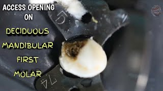 access opening on primary mandibular first molar  demo step by step [upl. by Edyth]