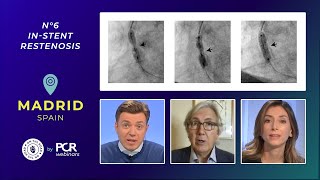 A patient with stent failure  how should I treat instent restenosis  Webinar [upl. by Vas]