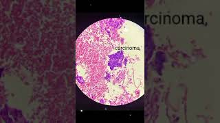 Invasive squamous cell carcinoma [upl. by Inanuah]