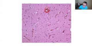 NEUROPATHOLOGY BOARD REVIEW 1 [upl. by Ititrefen921]