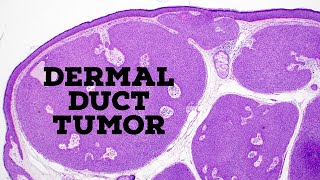 Dermal duct tumor vs poroma vs hidradenoma acrospiroma quotfamilyquot of sweat gland tumors dermpath [upl. by Newnorb370]