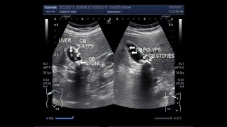 Differentiation between Gallbladder stones and Polyps [upl. by Enyalb]