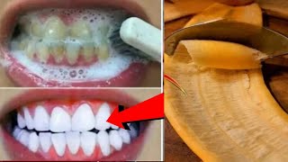 In Just 2minutes Whiten Yellow stained Teeth at Home BEST TEETH WHITENING REMEDY ll NGWorld [upl. by Uon]