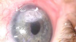 histoacryl for corneal perforation [upl. by Laurice]