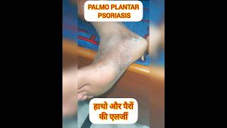 PALMOPLANTAR PSORIASIS psoriasis itching dryskin shortsfeed shortvideo shorts ytviral SHORT [upl. by Logan25]