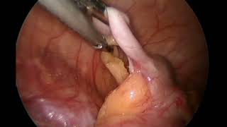 Laparoscopic Appendicectomy 24 [upl. by Airetas]