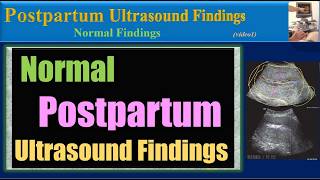 Normal Postpartum Ultrasound Findings [upl. by Tammany]