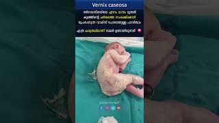 Vernix caseosa ❤️ trending [upl. by Ardnahcal]