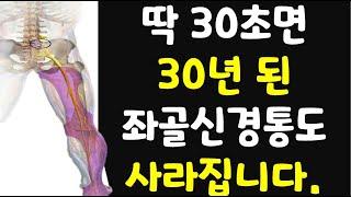 30초만에 방사통 일명 좌골신경통 즉시 없애주는 기가 막히는 운동 [upl. by Nussbaum840]