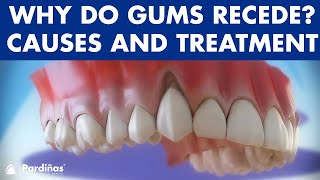 Gum recession  Treatment of gingival retraction © [upl. by Todhunter987]