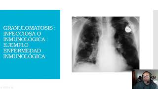 PRACTICA DE NODULOS PULMONARES MULTIPLES [upl. by Isola117]