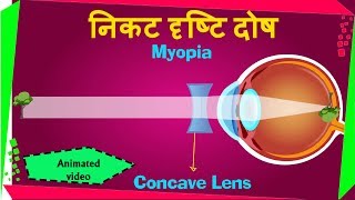 Myopia निकट दृष्टि दोष \ Short Sightedness in Hindi \ cbse and ncert Science [upl. by Godred303]