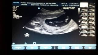 11 weeks and 3 days pregnant ultrasound [upl. by Nala924]