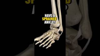 How to Fix A Sprained Ankle 3 STEPS [upl. by Fogel]