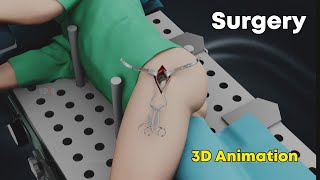 SuperPath Hip Replacement Surgery  3D Animation [upl. by Hgielar396]