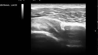 洪辰宇醫師 肩關節喙突下夾擠症候群 超音波動態檢查  Subcoracoid impingement dynamic US examination [upl. by Aivilo971]