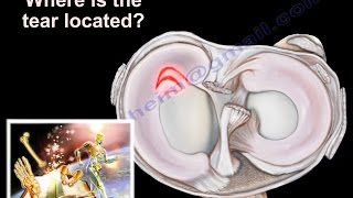 Knee Pain  Meniscus tear  Everything You Need To Know  Dr Nabil Ebraheim [upl. by Bodwell17]