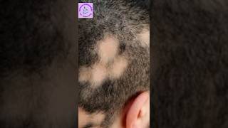 Alopeciatreatment with homoeopathy Arnica hair oilShampoo German medicine R 89 drops [upl. by Gnus]