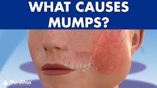 Mumps parotitis and other salivary glands conditions sialadenitis sialolithiasis mucocele © [upl. by Ateekahs385]