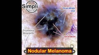 Nodular Melanoma Dermoscopy [upl. by Odlanyar]