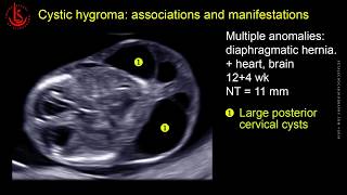 Cystic hydroma and nuchal edema at 1113 weeks of pregnancy [upl. by Micky]