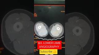 BL LOWER LIMB ANGIO youtubeshorts viralshorts hemantkushwah3453 [upl. by Sapphera]