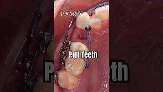 How to pull teeth when braces braces orthodontist dentist dental [upl. by Lianne]