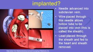 Pacemaker Patient Education Lecture 3 What are Pacemakers and How Do They Work [upl. by Haiacim]