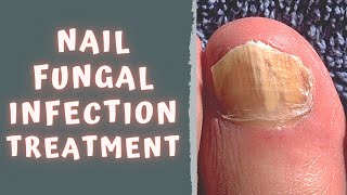 HOW TO TREAT FUNGAL NAIL INFECTION  TINEA UNGUIUM  ONYCHOMYCOSIS [upl. by Nguyen]