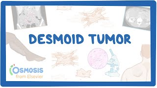 Desmoid Tumor NORD [upl. by Metah]