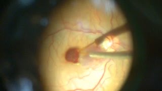 Displacement of subfoveal hemorrhage by perfluorocarbon subfoveal hemoraji yer değiştirilmesi [upl. by Varhol]